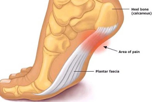 Plantar Fasciitis